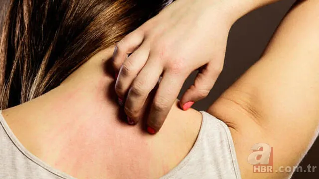 Bu belirtiler varsa dikkat! Ciltte geçmeyen kaşıntı kızarıklık... Uyuz neden olur, tedavi yöntemi nelerdir? Hastalık tanısı... 3