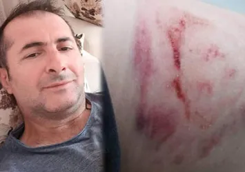 Alkollü hasta doktora sataştı sağlık çalışanının kolunu ısırdı
