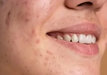 Yüzdeki sivilceler ne zaman tehlikeli bir hale gelir?