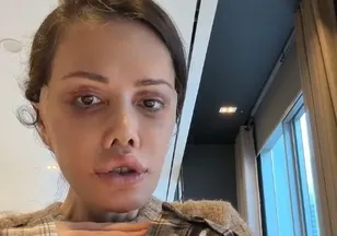 Yüz nakli olan Didem Ceran kansere yakalandı