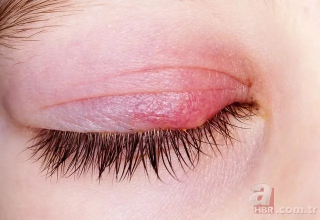 Gözde arpacık neden çıkar, nasıl geçer? 4