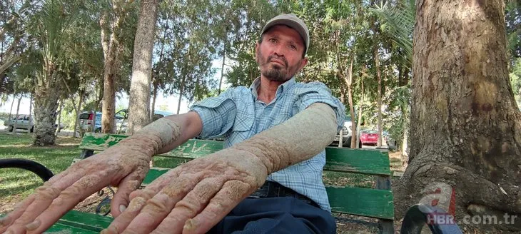 26 yıldır sedef hastalığıyla mücadele ediyor! Görenlerin kaçmasına alışamadı