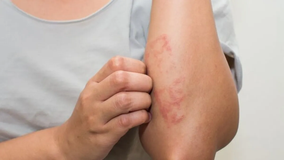 Egzama nasıl geçer? Egzama nedenleri ve belirtileri...