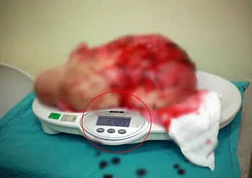 Doktor bile gözlerine inanamadı! Kilolarca çıktı
