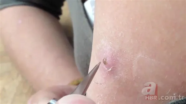 Kolundaki sivilceden böcek çıktı 👩⚕️ Doktora gidince şoke oldu | Cımbızla çektikçe içi gitti 1