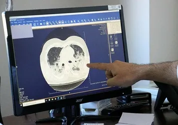 Koronavirüs böyle zarar veriyor! İşte tomografi görüntüsü