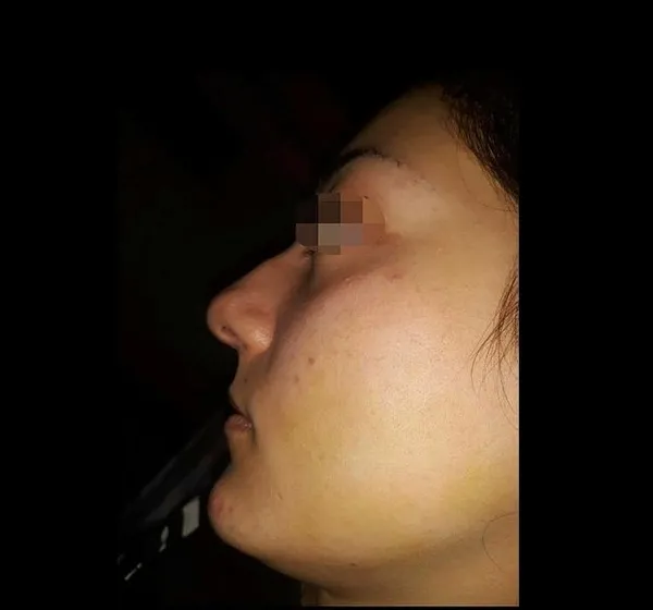 1672027870048.jpg Yeni evli kadın kabusu yaşadı! Severek evlendiği kişi kaburgasını çatlatıp vücudunda sigara söndürdü - 2