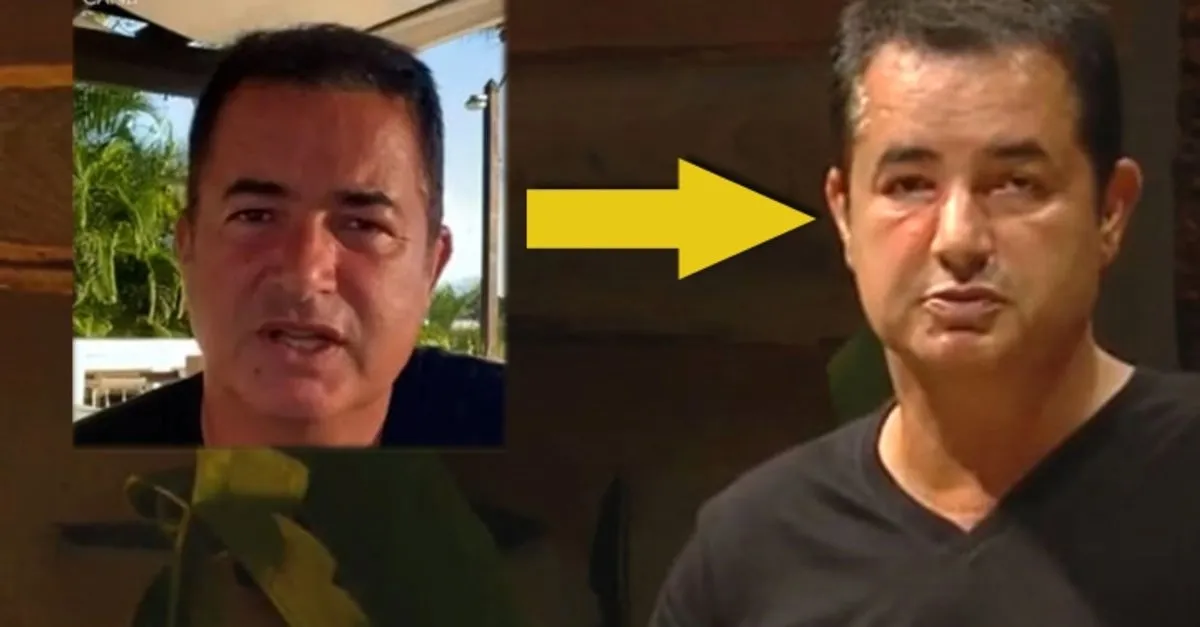 acun ilicali ilk kez anlatti iste gozundeki sisligin nedeni video izle magazin haberleri ahaber video izle