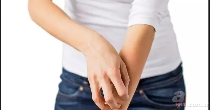 Kurdeşen dökmek ne demek? Kurdeşen (ürtiker) nedir, neden olur, sebepleri neler? Tedavisi var mı, ne iyi gelir? 2