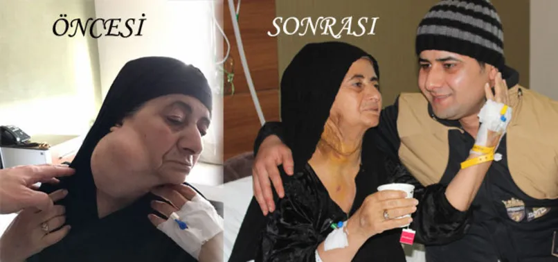 30 yıl boyunca boynunda 1 kilo tümör ile yaşadı