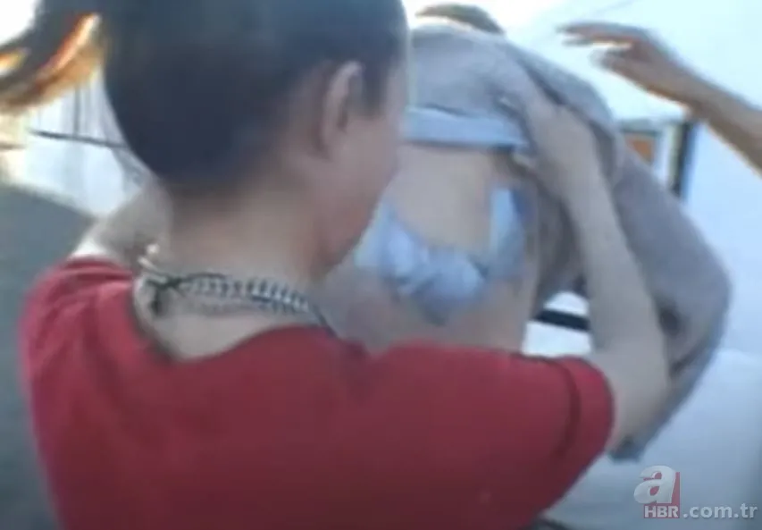 Sırtındaki yarayı sivilce zannetti ama gerçek dehşete düşürdü! Bakın içinden ne çıktı 3