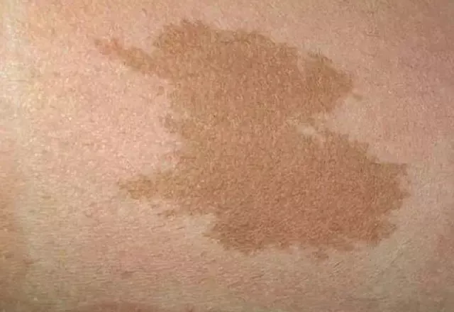 Bu belirtiler varsa dikkat! Diş gıcırdatma, aşırı terleme...