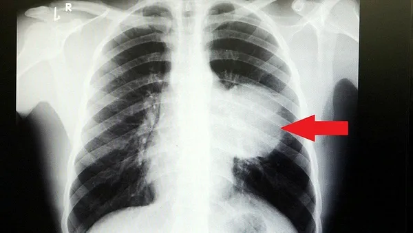 1699190533501.jpeg Röntgeni görünce doktorlar bile şaşkına döndü! Kalbi 12 santim kaydı, içinden kilolarca... - 3