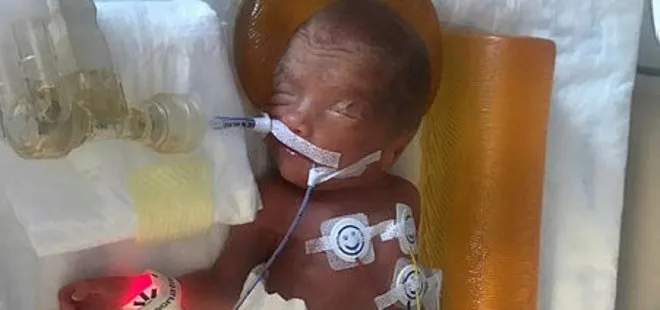 İzmir’de 24 haftalık doğan mucize bebek İdil, yaşama tutundu