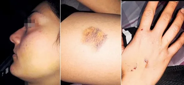 1672027861622.jpg Yeni evli kadın kabusu yaşadı! Severek evlendiği kişi kaburgasını çatlatıp vücudunda sigara söndürdü - 4