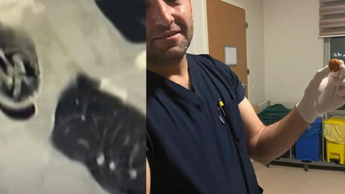 Şaşkına çeviren olay! Nefes darlığı ve öksürük sebebi "ceviz" çıktı