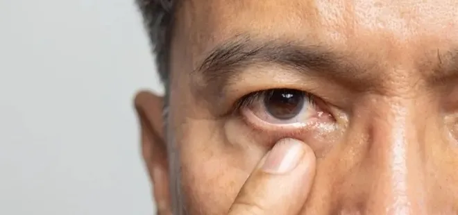 Gözlerdeki bu değişim yüksek kolesterolün habercisi olabilir!