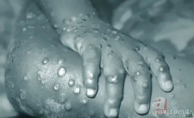 Maymun çiçek virüsü yeni salgına davetiye çıkardı! Avrupa’da vaka sayısı artışta, tedavisi yok 8