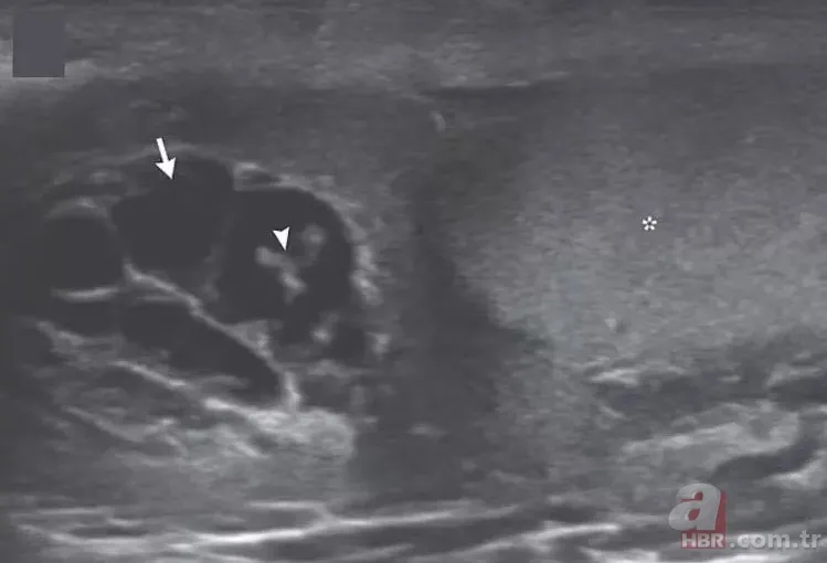 Doktora gitti hayatının şokunu yaşadı 👨⚕️ Sivrisinek ısırığı kabusu oldu 🦟 Dans eden düzinelerce... 3