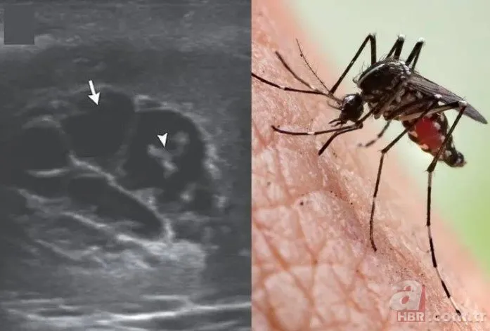 Sivrisinek ısırığı kabusu oldu 🦟 Doktor ultrason ekranına bakınca şaşkına döndü 👨‍⚕️ Dans eden düzinelerce...