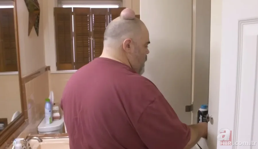 Sokağa şapka ile çıkıyordu! Başındaki şişlikten bakın ne çıktı 👩⚕️ Görenleri şaşkına çeviren olay 15