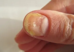 Tırnak mantarının kökünü kazıyor, 1 damla sürmek yetiyor