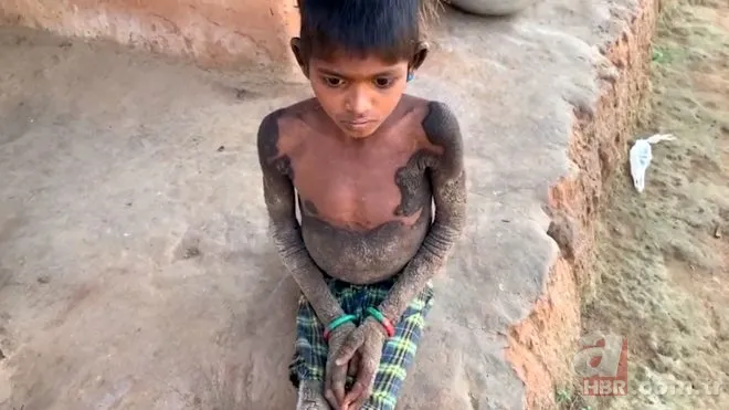 Vücudu her geçen gün taşa dönüşüyor! 2