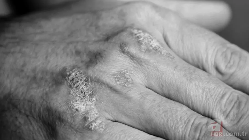 Egzamanın kökünü kurutan doğal ilaç tarifi! 7