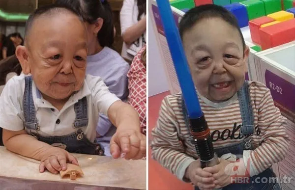 Dünyanın en tuhaf hastalıkları 7