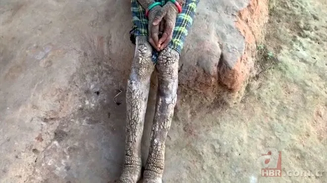 Vücudu her geçen gün taşa dönüşüyor! 3