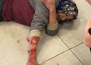 Köpek kadının kolundan parça kopardı