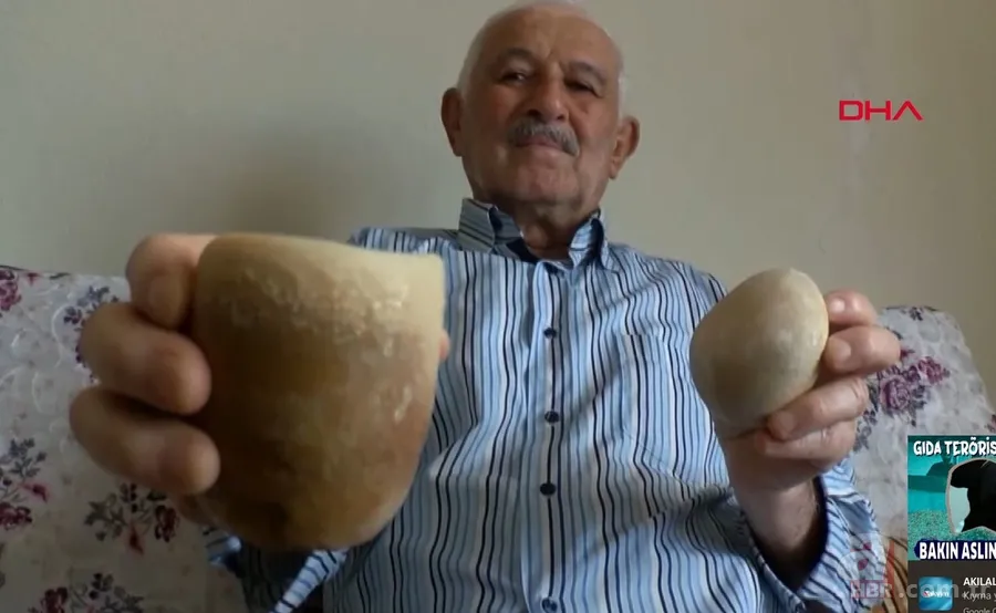 Karın bölgesinde şişlik ve halsizlik şikayetiyle doktora gitti! Karnından çıkanlar şoke etti 16