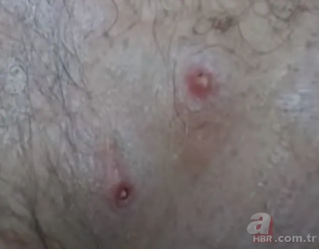 Sırtındaki yarayı sivilce zannetti ama gerçek dehşete düşürdü! Bakın içinden ne çıktı 19