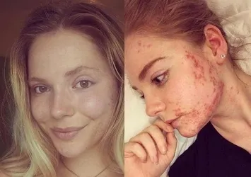 O besini kesti, tüm aknelerinden kurtuldu