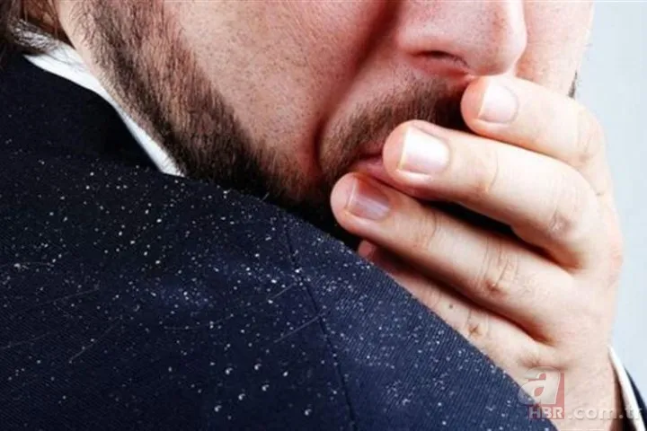 Kepek kabusuna "doğal" çözüm! 1