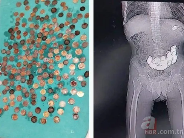 Ne olduysa 3 ayda oldu! X-Ray cihazına bakan doktorlar şaştı kaldı! Hepsi midesinden çıkarıldı