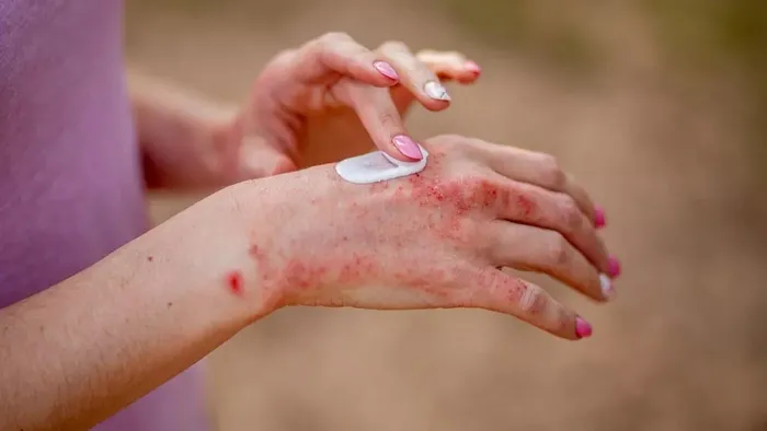 Egzama belirtileri nelerdir? Egzama nasıl geçer, ne iyi gelir?