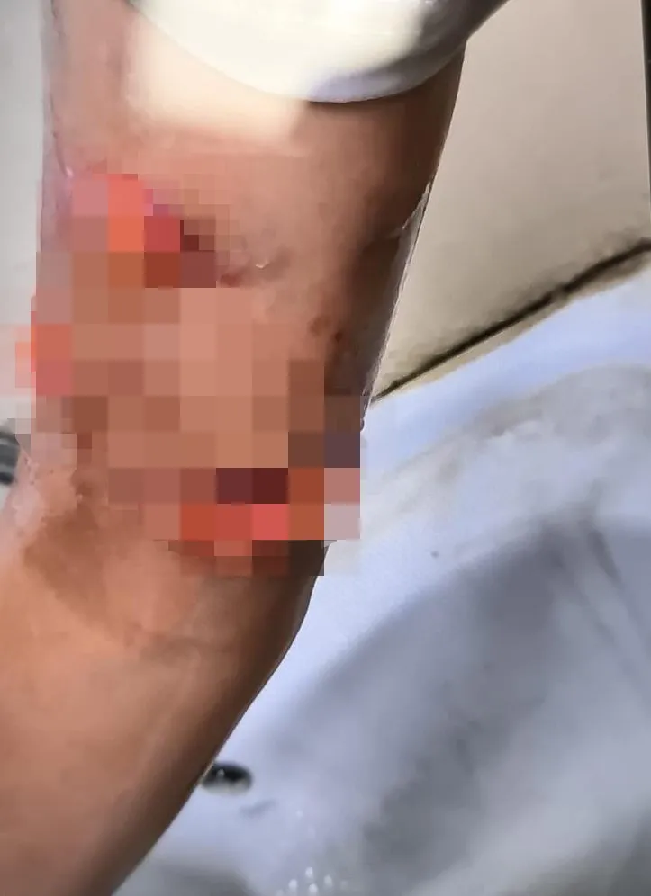 Suruç'ta başıboş köpek dehşeti! 8 yaşındaki Evin'e 150 dikiş! Faciayı sürücü önledi - 4