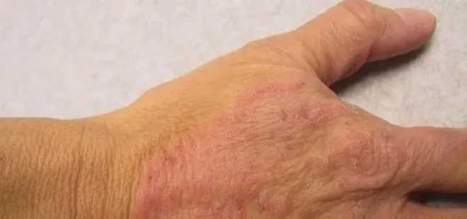 Sıcak ve nem mantar vakalarını artırıyor