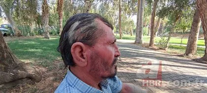 26 yıldır sedef hastalığıyla mücadele ediyor! Görenlerin kaçmasına alışamadı