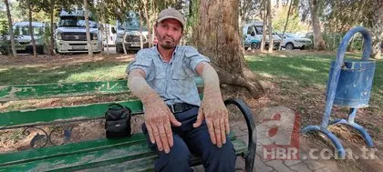 26 yıldır sedef hastalığıyla mücadele ediyor! Görenlerin kaçmasına alışamadı