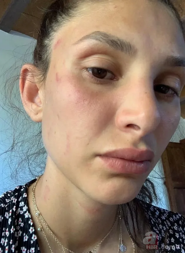 Can Yaman'ın şiddet gören sevgilisi kanlar içinde paylaştı! "Gerçekleri konuşma zamanı" 6