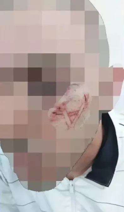 İsrail’de zulüm üstüne zulüm! Filistinli gencin yüzüne metal bir alet ile Davud Yıldızı kazıdılar