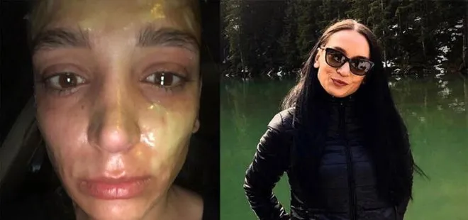 İstanbul’da genç kadının yüzüne lavabo açıcı patladı