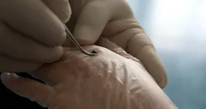 Adıyaman’da kadının kulağını kene ısırdı