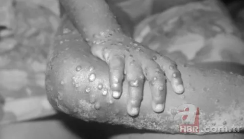 Maymun çiçek virüsü yeni salgına davetiye çıkardı! Avrupa’da vaka sayısı artışta, tedavisi yok 9