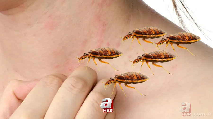 Uyuz hastalığı nedir, belirtileri neler? İnsandan insana uyuz nasıl geçer, kaşıntıya ne iyi gelir, tedavisi var mı? 1