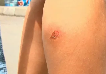 Son dakika: İstanbul'da Asya Kaplan Sivrisineği kabusu!