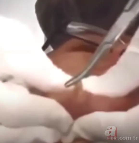 Çenesindeki şişliği sivilce zannetti ama gerçek bambaşka çıktı! Dehşete düşüren olay