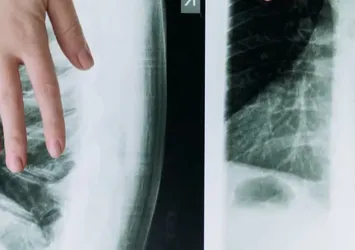 Türkiye’nin kanser haritası! İşte kanser ölüm oranlarının yüksek olduğu iller